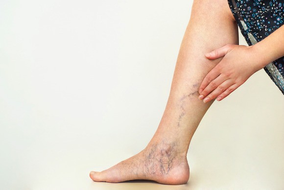 Experience the Benefits of Laser Vein Reduction at Angelic Medi Spa
