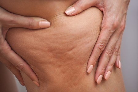 Say Goodbye to Unsightly Cellulite! 