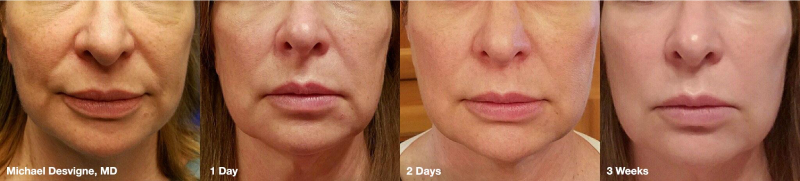 Before & After