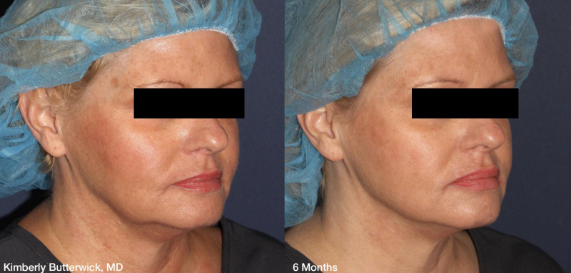 Before & After