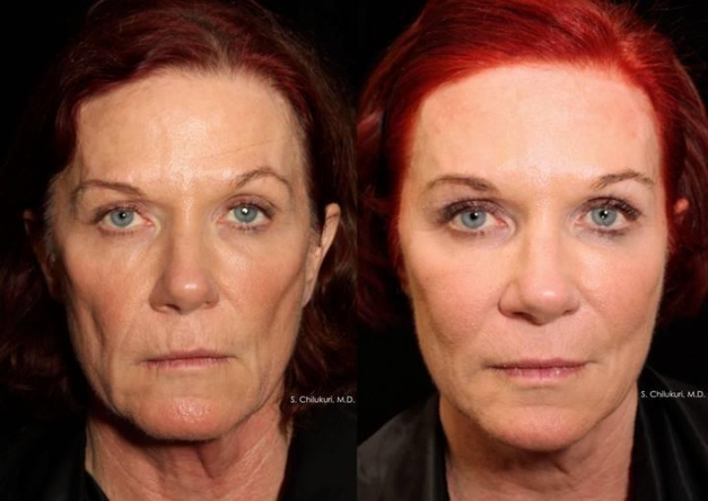 Before & After